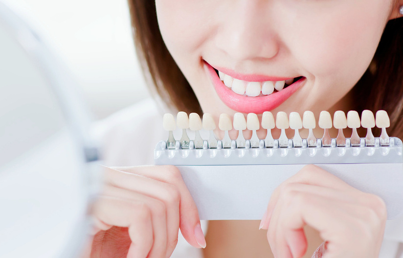 シェードガイドを持つ、歯が白い女性